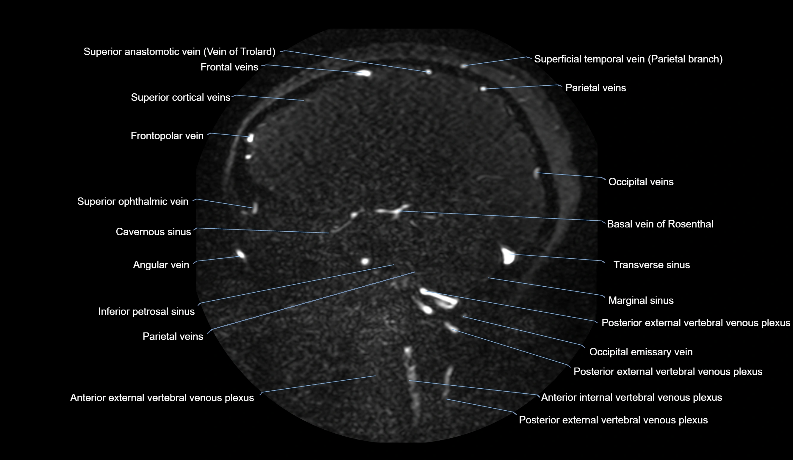 MRV brain sagittal anatomy 3T MRI images -img-01015-00034.webp